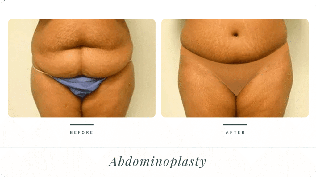 Abdominoplasty-2-LT