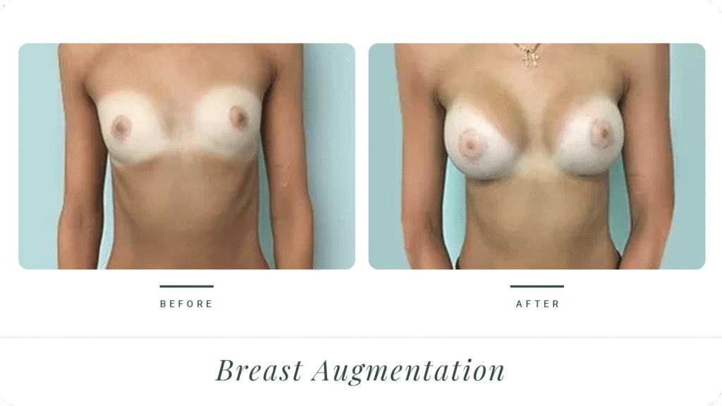 Breast-Augmentation-2-LT