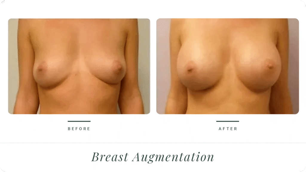 Breast-Augmentation-3-LT