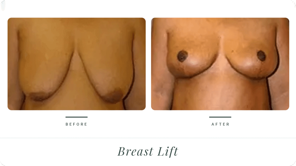 Breast-Lift-3-LT