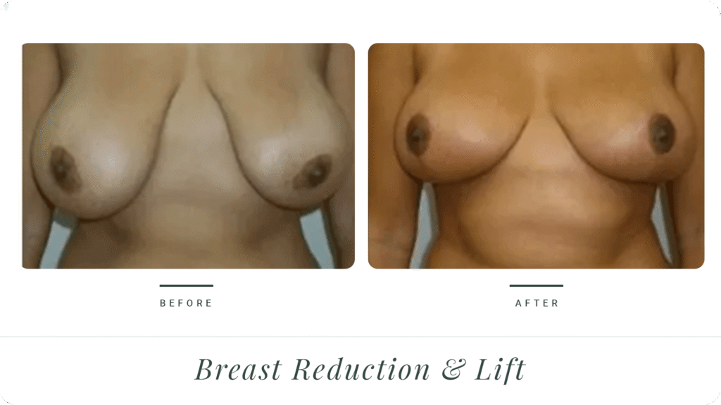 Breast-Lift-&-Reduction-LT