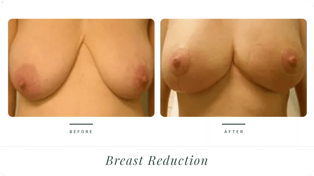 Breast-Reduction-3-LT