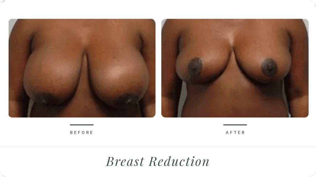Breast-Reduction-5-LT