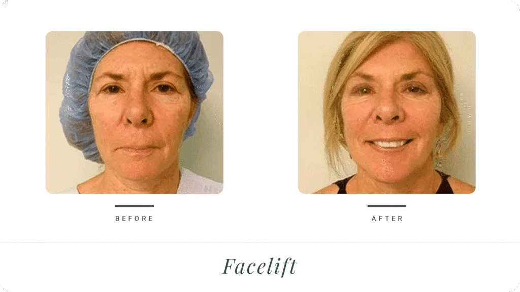 Facelift-2-LT