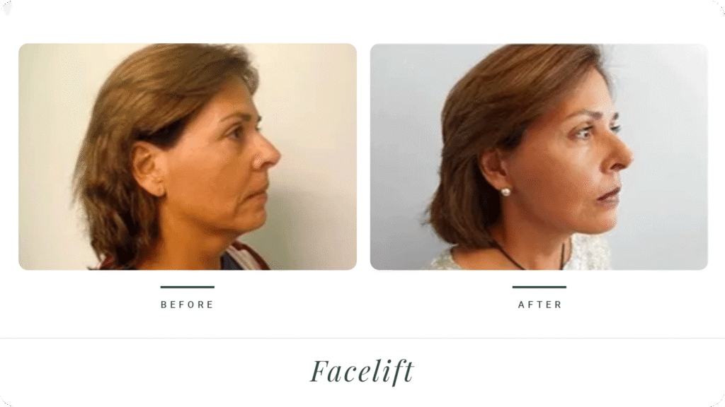 Facelift-3-LT