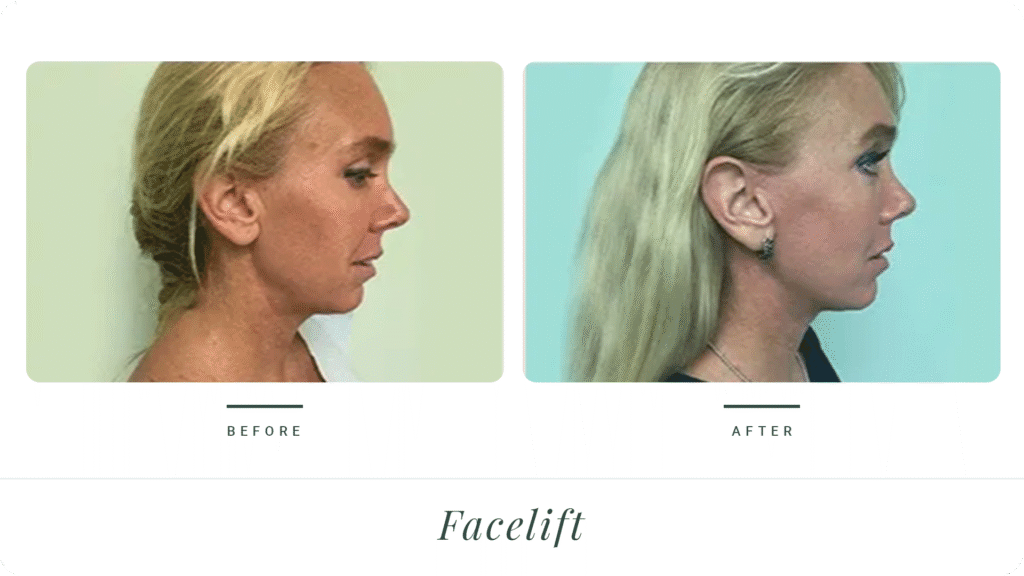 Facelift-LT