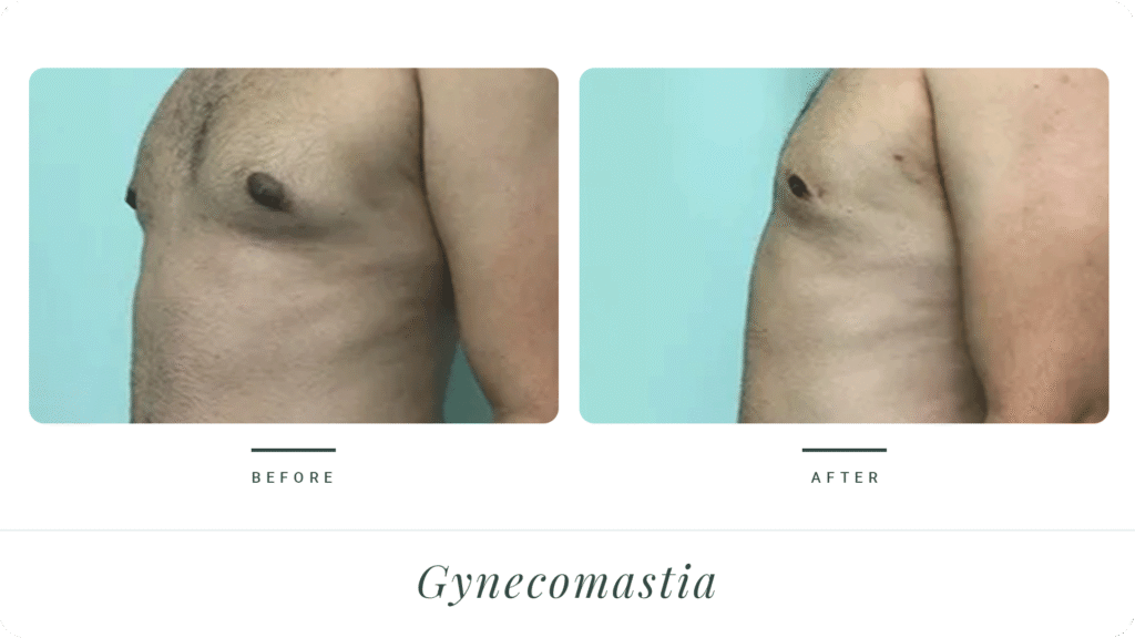 Gynecomastia-L2-T