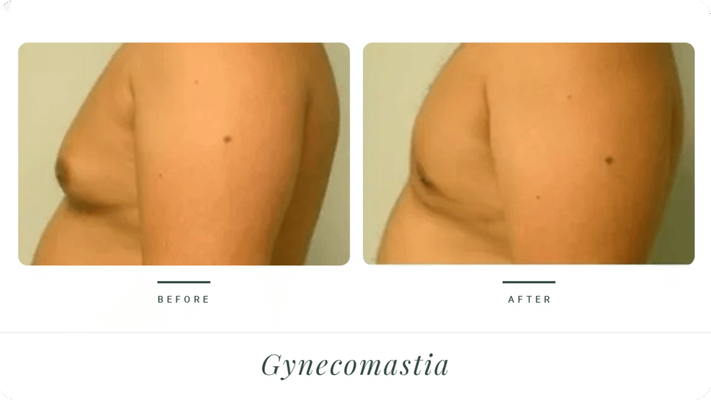 Gynecomastia-LT