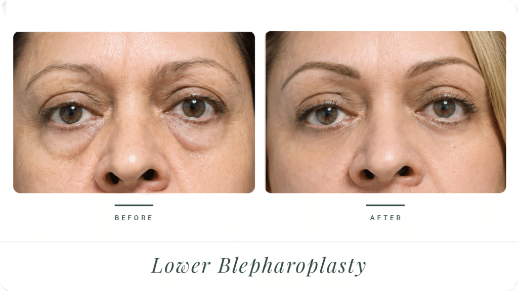 Lower-Blepharoplasty-2-LT