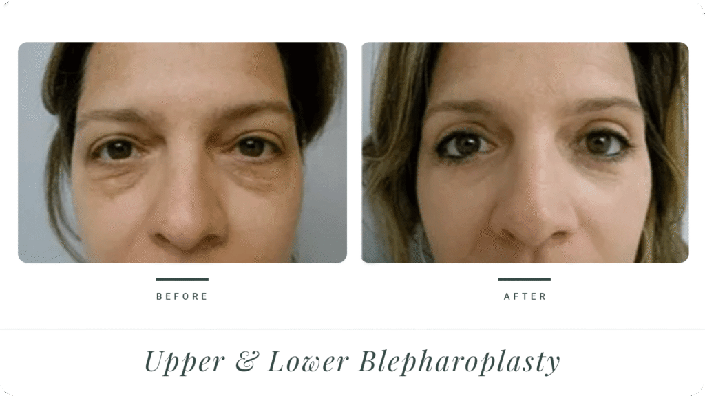 Upper-&-Lower-Blepharoplasty-2-LT
