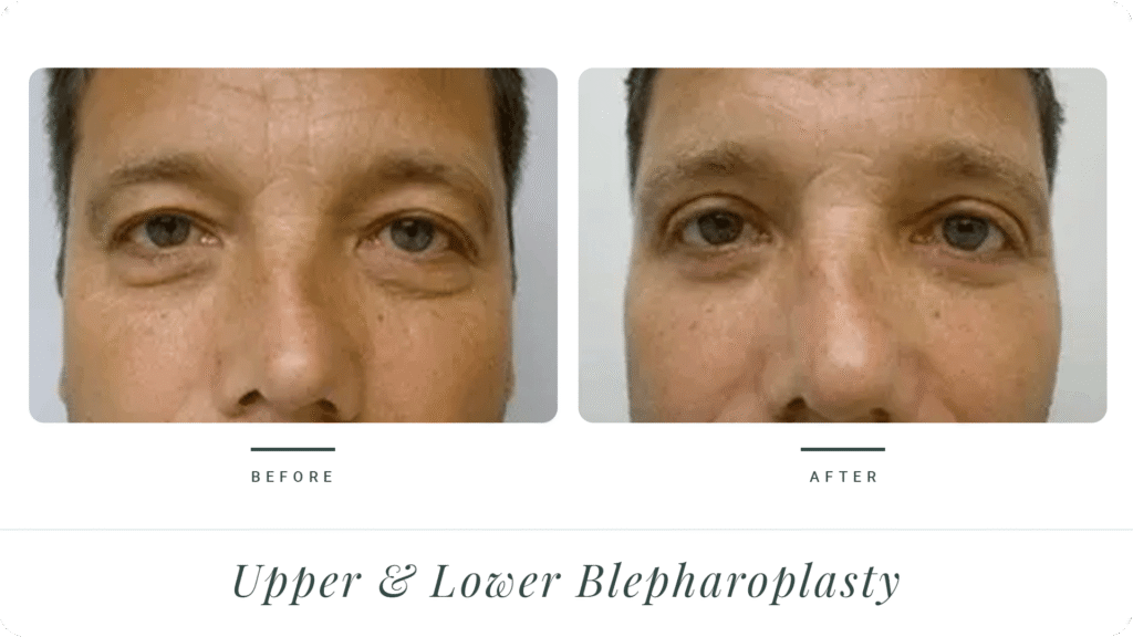 Upper-&-Lower-Blepharoplasty-LT
