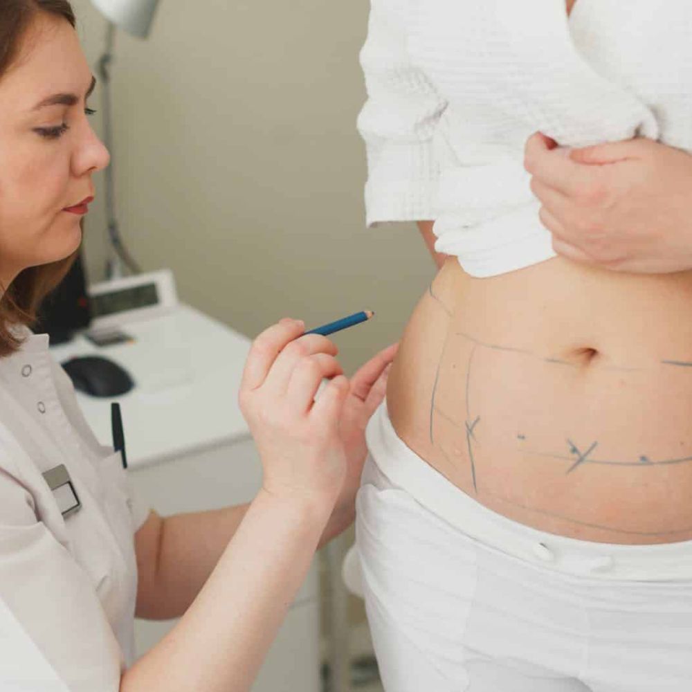 Liposuction and Tummy Tuck in the USA